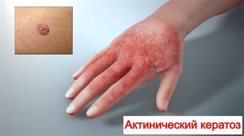 Актинический (старческий, «солнечный») КЕРАТОЗ - YouTube