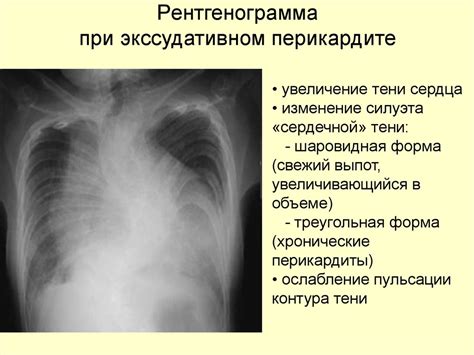 Перикардит. Распространенность и этиология перикардитов - презентация ...