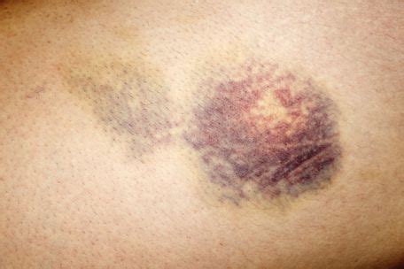 purpura  types  symptoms