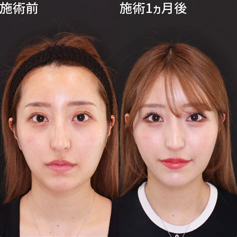口横のもたつきが改善し小顔美人に♪美人小顔脂肪吸引ならDr.モリモリ｜症例写真・ビフォーアフター｜美容整形･美容外科のTAクリニックグループ