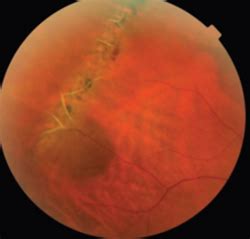 Lattice Degeneration – Retina Orange County