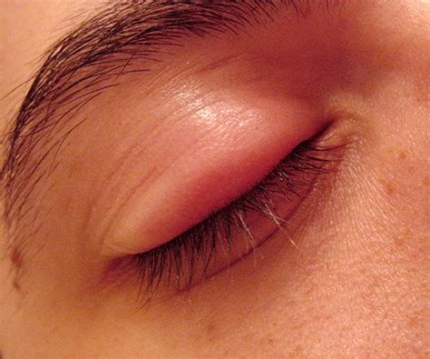 Swollen Eyelid - Symptoms, Treatment, Pictures, Causes | HealDove