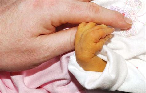 New smartphone app identifying jaundice from babies’ eyes ‘could save