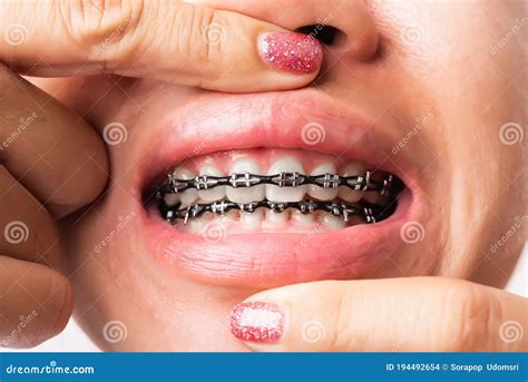 Black Braces: A Comprehensive Guide to Modern Orthodontic Treatment