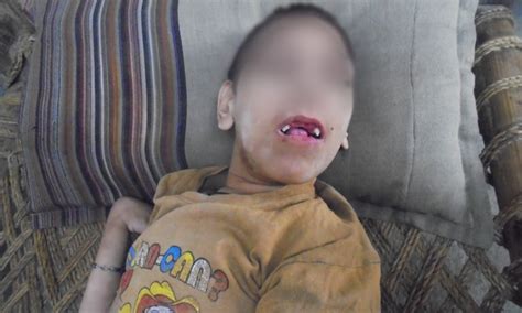 Deformities in Charsadda: Cousin marriages, and the heavy price ...