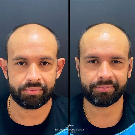 Otomodelação Antes E Depois - DR. JOÃO MARCOS | MÉDICO | Veja a diferença entre o antes e o depois da ...