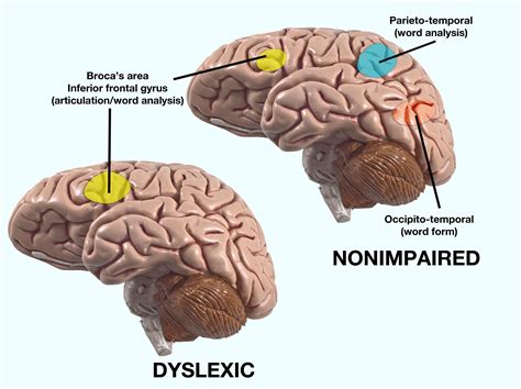 brain dyslexic broca understand neuro distinct uses places