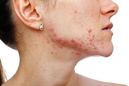 Stubborn acne? Hormonal therapy may help: Foothill Dermatology Medical ...