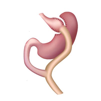 gastric bypass dr zafar iqbal gondal