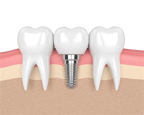 The Role Of Dental Implant Abutment For Successful Result | Dr. Alex ...