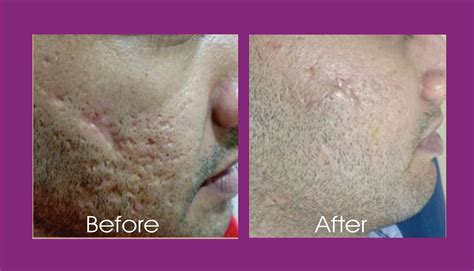 Skin Resurfacing / Acne Skin Reduction | M A Skin & Super Speciality ...