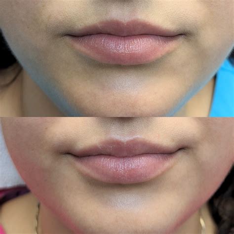 Therapeutic Injections | Dentist in Leesburg, VA