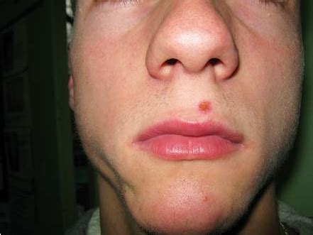 morphea face morphea clinical  history physical