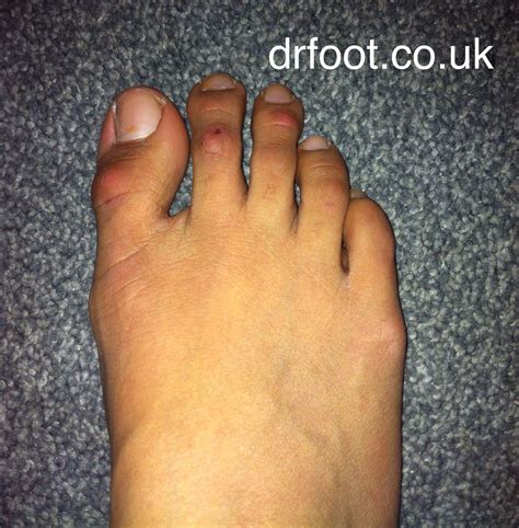Hammer toes | Hammer toe, Toes, Feet