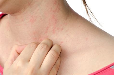 Eczema - Gupta Allergy | Allergy & Asthma Specialists