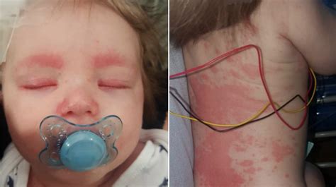 Meningitis rash completely covers baby's body in 12 hours, mom warns - CBS News