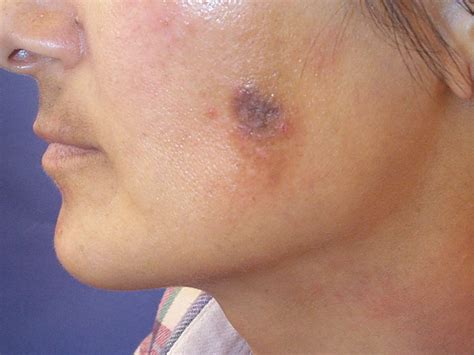 types  skin lesions    treat