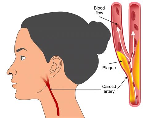 The Hidden Danger: How Peripheral Artery Disease Increases Your Risk of