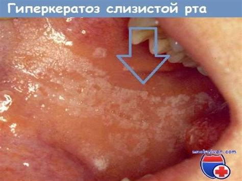 Планирование помощи больному с гиперкератотическими поражениями ...