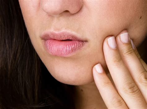 putting salt  canker sore  acadanow