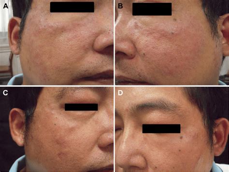 multiple reddish papules  plaques arranged  annular shape
