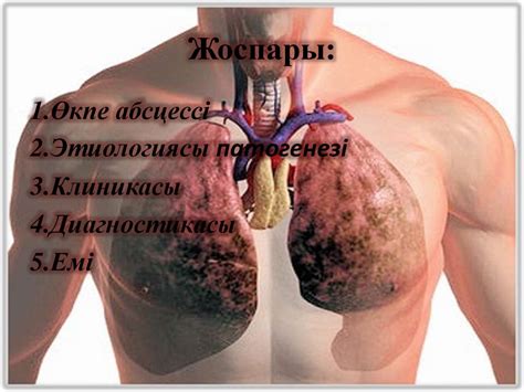 Өкпе абсцессі - презентация онлайн