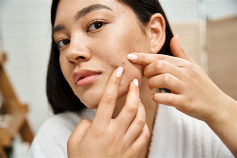 pcos acne      zoe nissi