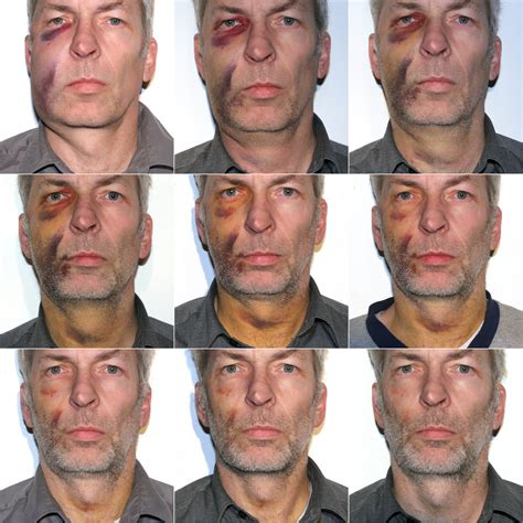 how to prevent swelling after wisdom teeth removal 3