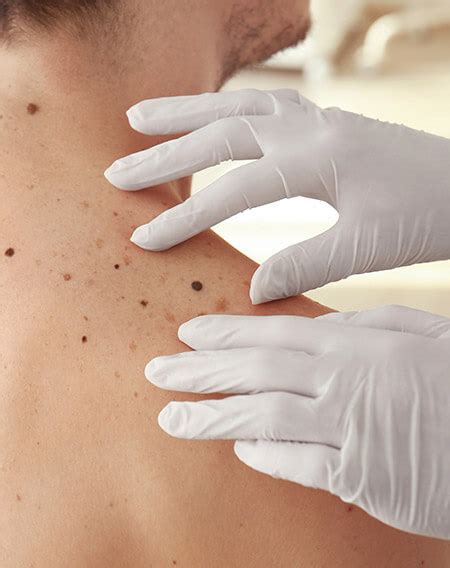 Mole Mapping – House of Dermatology