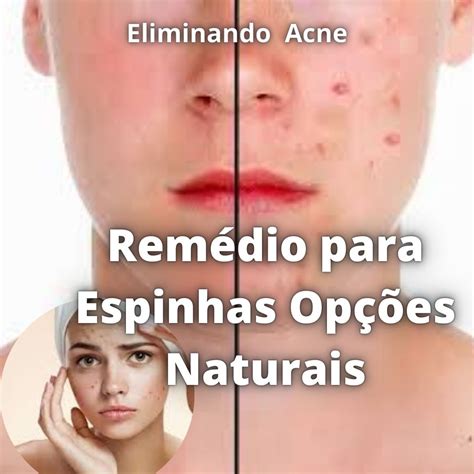O Que É Bom Para Espinha Caseiro - ( Remédio Caseirinho para Espinhas Opções Naturais ) - Jorge Luiz