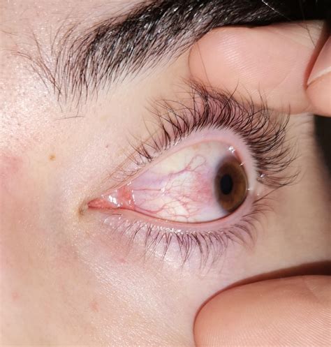 Is this an eye infection? : r/medical