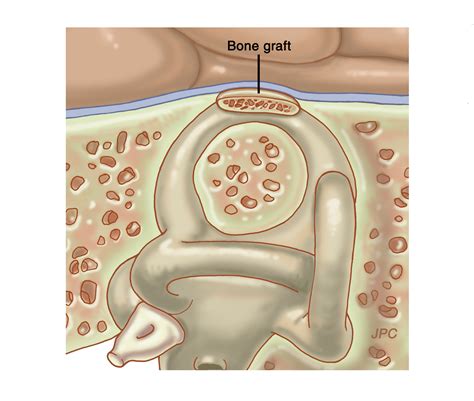 Superior Canal Dehiscence | Earsite.com