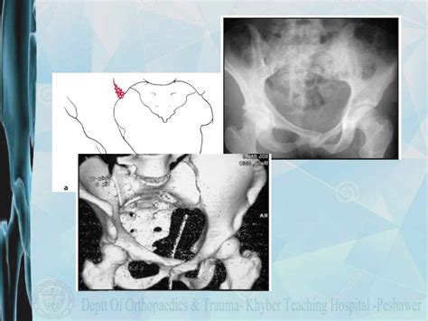 Pelvic fracture classification