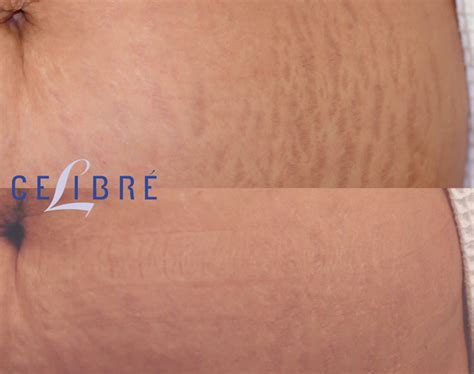 permanent makeup stretch marks    saubhaya makeup