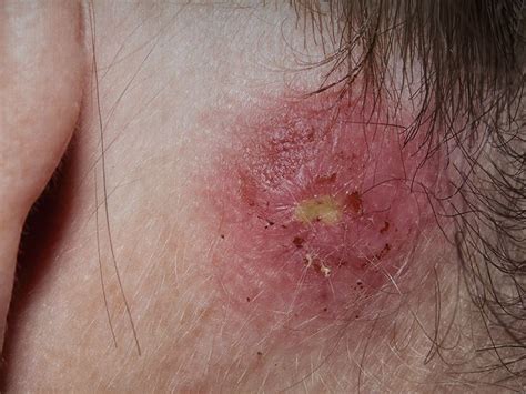 staph infection types symptoms  treatments
