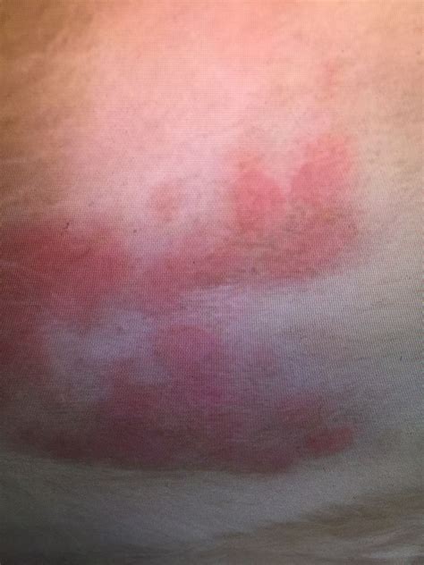 Rash On Cat's Lower Belly at Roderick Tipton blog