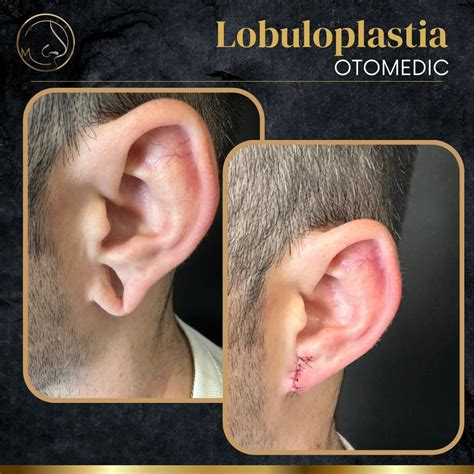 Lobuloplastia O Que É - **Lobuloplastia: Transformando Vidas na Nossa Clínica!** Na nossa ...