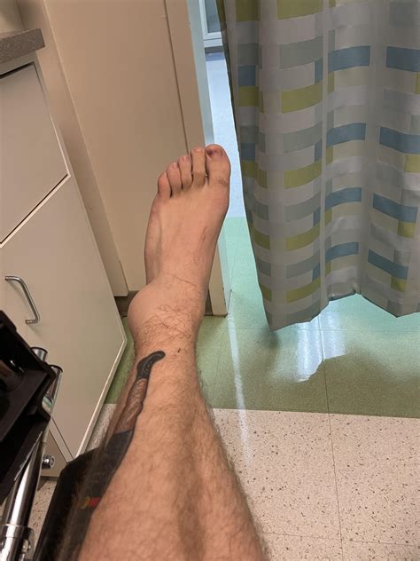 Not today. Torn ligaments and tendons, but not a single crack : r