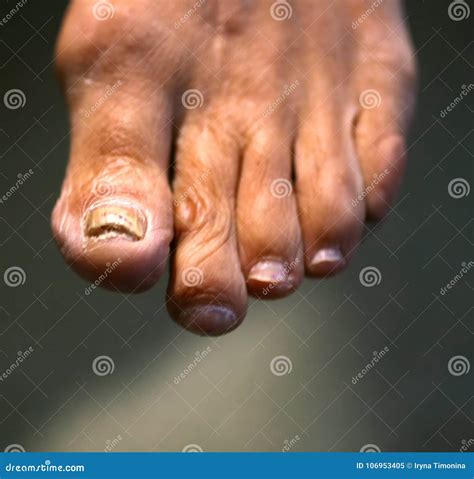 Fungus on the Nail. Twisted Fingers on the Foot with Calluses. Bone on