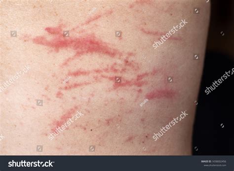 1,165 Excoriations Images, Stock Photos & Vectors | Shutterstock