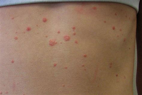 Mild Psoriasis Arm