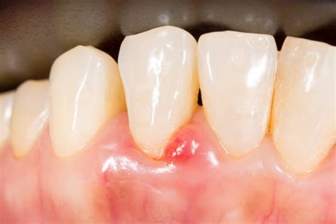 gingival swelling stock  pictures royalty  images istock