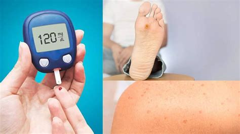 Diabetes Signs: 5 Symptoms of Diabetes You Can Spot On Your Skin ...