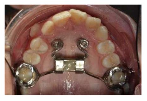 Herbst Appliance Reinforced with an Hybrid Hyrax Expander and Two