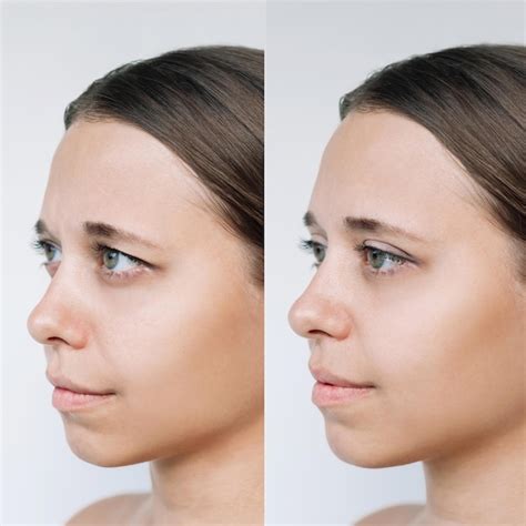 Premium Photo | Young woman face with drooping upper eyelid before ...