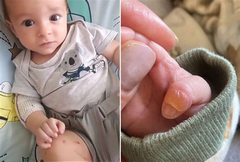 Bolinhas De Calor No Corpo Do Bebe - Bolhas no corpo de recém-nascido revelam doença sem cura, em SP: “Meu ...