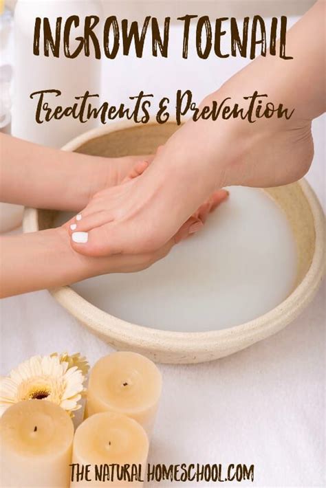 Ingrown toenail treatments prevention – Artofit
