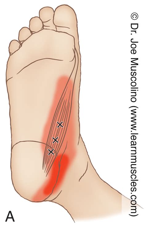 Abductor Hallucis - Trigger Points - Learn Muscles