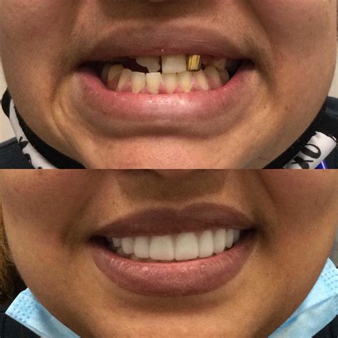 Memphis Dentures and Implants