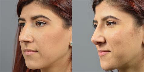 Nose Surgery Before & After Patient 36 | Dr. Marotta